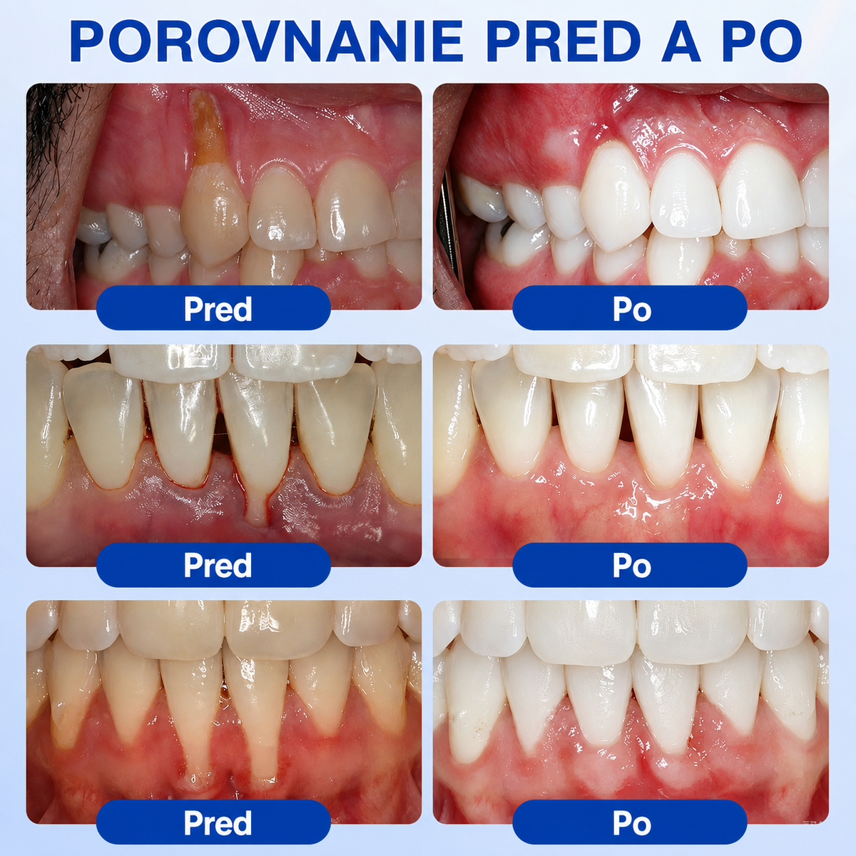 👨‍⚕️🦷 Evolvion® GumRevive regeneračný gél na parodont🎁